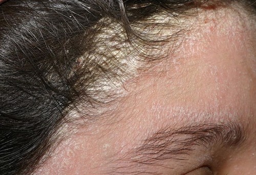 Kiên trì hỗ trợ điều trị vẩy nến da đầu